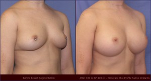 breast-augmentation-23a