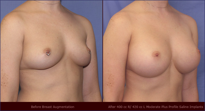 inexpensive breast enlargement