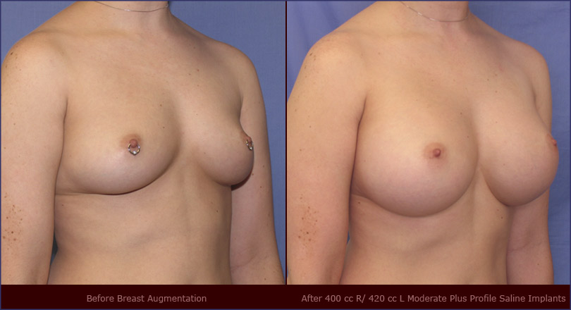 Not Nude breast enlargement sexy Those on! Nude breast enlargement sexy necessary words
