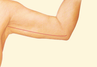 Arm Lift after