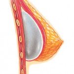 Breast Augmentation submuscular