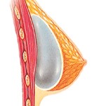 Breast Augmentation above muscle