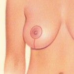 Breast Lift 04