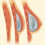 Breast Reconstruction implant