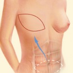 Breast Reconstruction TRAM