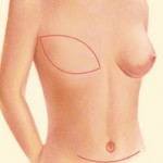Breast Reconstruction TRAM scar