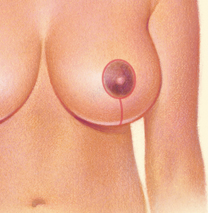 Breast Reduction lollipop scar