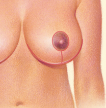 Breast Reduction anchor scar