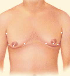 Breast Reduction for Men Liposuction in Utah