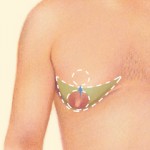 Breast Reduction for Men