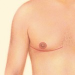 Breast Reduction for Men 06