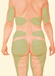 Liposuction Utah