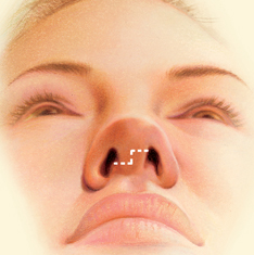 Nose Surgery incision