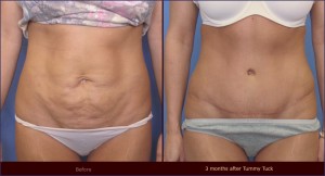 mesotherapy complication on left