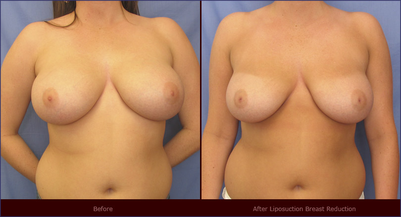 breast reduction pictures