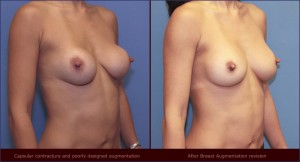 breast implant below muscle