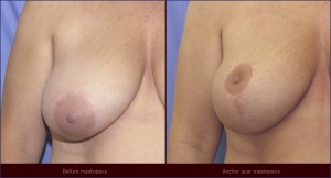 breast reduction scar