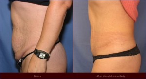 mini-tummy-tuck-1a mini-tummy-tuck-1a