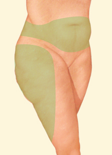 Liposuction of the thighs