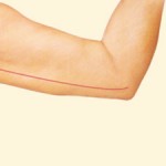 Arm Lift after weight loss