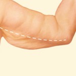 Arm Lift after weight loss