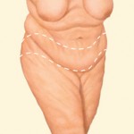 Tummy tuck after weight loss