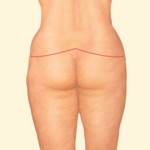 Body Lift after