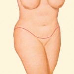 Abdominoplasty after weight loss