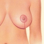 Breast Lift after weght loss