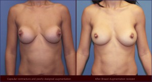 Capsular-contracture breast implant