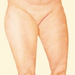 Thigh Lift after