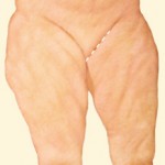inner Thigh Lift
