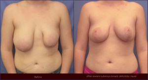 Tuberous-breast-reconstruction