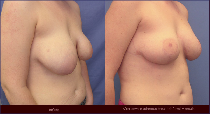 Areola Reduction Photos