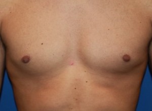 nipple post