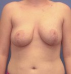 Breast Reconstruction Patient 32523 Photo 2