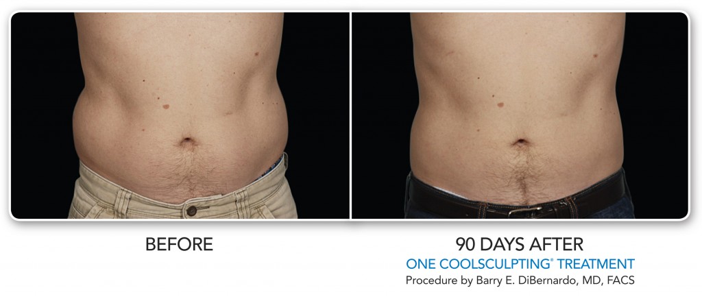 Utah coolsculpting