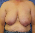 Breast Reconstruction Patient