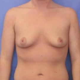 Breast Augmentation Patient 25671 Before Photo # 1