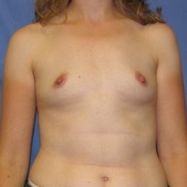 Breast Procedures Patient 40291
