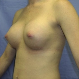 Breast Procedures Patient 32712 After Photo # 4