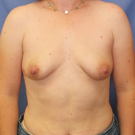 Breast Procedures Patient 71522