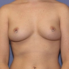 Breast Augmentation Patient 27910 Before Photo # 1