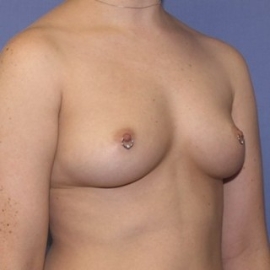 Breast Augmentation Patient 27910 Before Photo Thumbnail # 3
