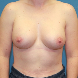 Breast Procedures Patient 71522