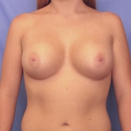 Breast Augmentation Patient 25671 After Photo # 2