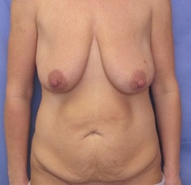 Breast Augmentation Patient 72458