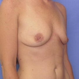 Breast Augmentation Patient 98047 Before Photo # 3