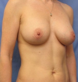 Breast Augmentation Patient 41496 After Photo # 4
