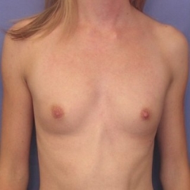 Breast Procedures Patient 45063 Before Photo Thumbnail # 1